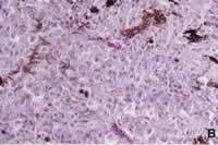 Epithelioid-Cell Type Melanoma