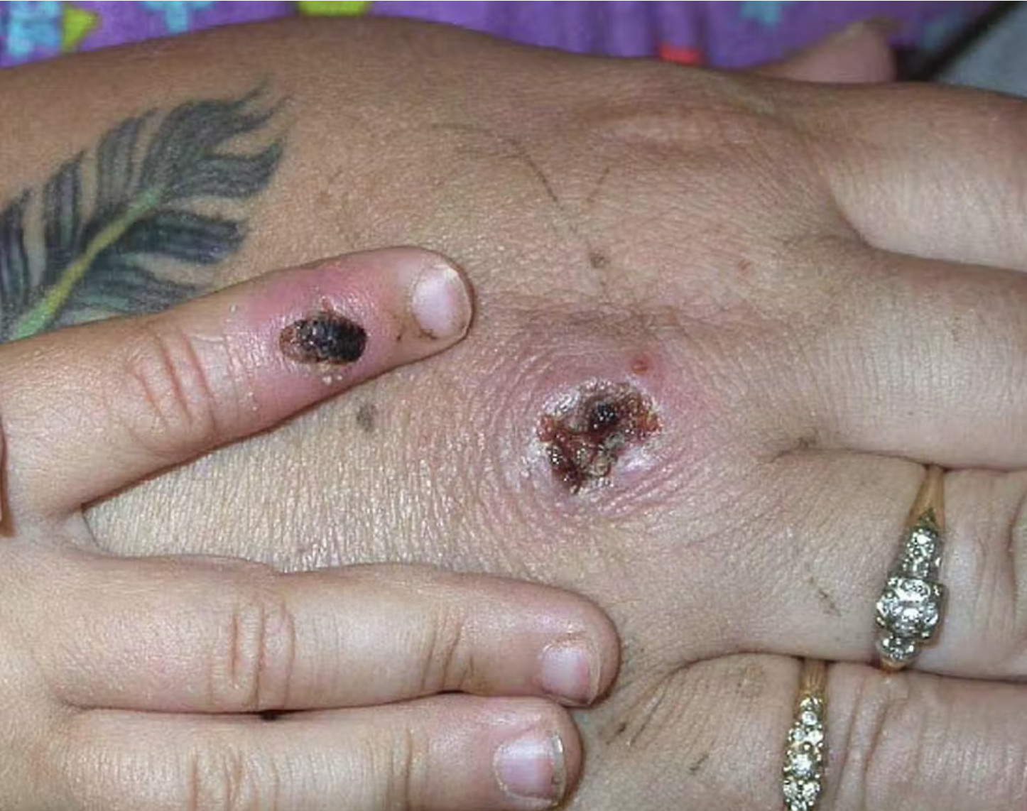 monkeypox scabs on hands