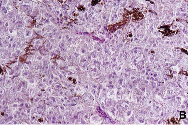 Epithelioid-Cell Type Melanoma (magnified)
