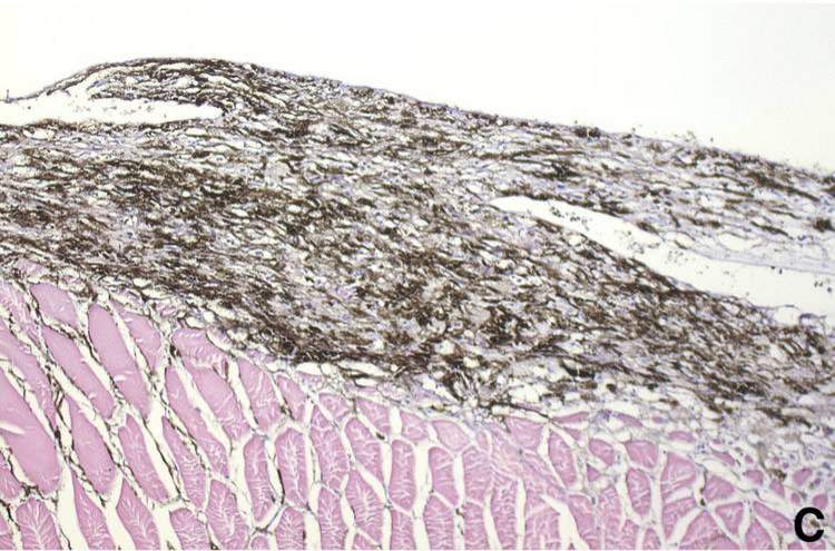 Spindle Cell Type Melanoma