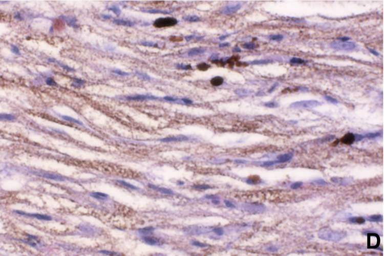 Spindle Cell Type Melanoma (magnified)